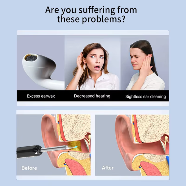 Smart Ear Wax Removal Camera